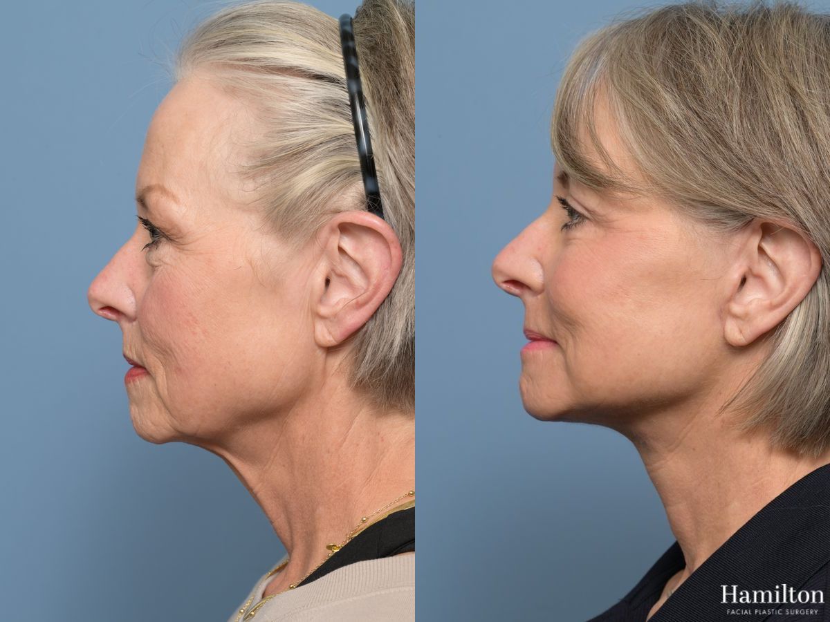 Before and after Facelift - Extended Deep Plane case 43412 - Angle 2