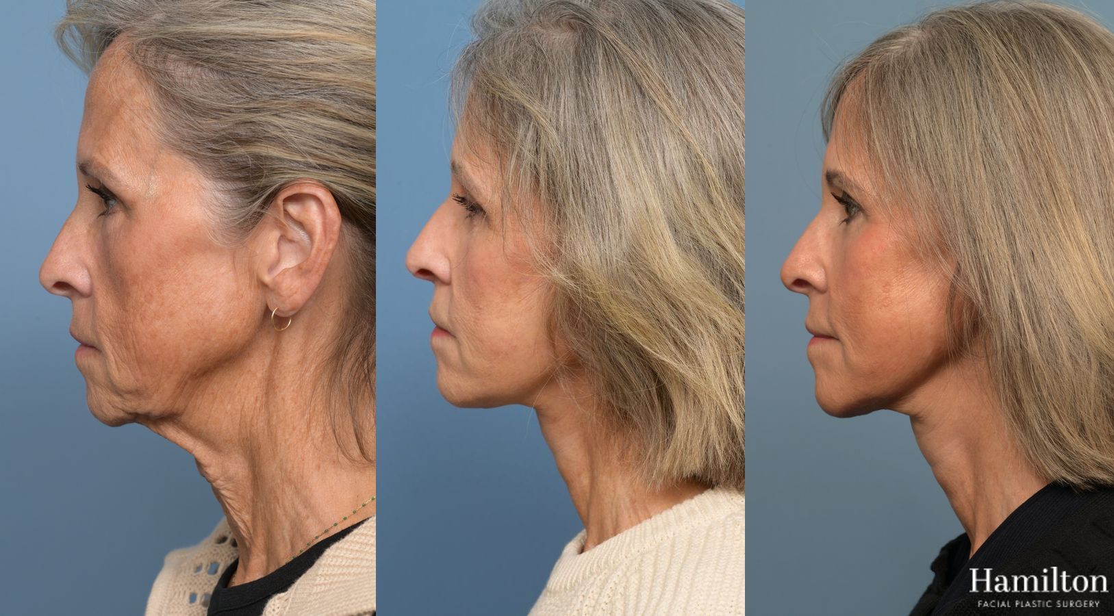 Before and after Facelift - Extended Deep Plane case 37219 - Angle 5