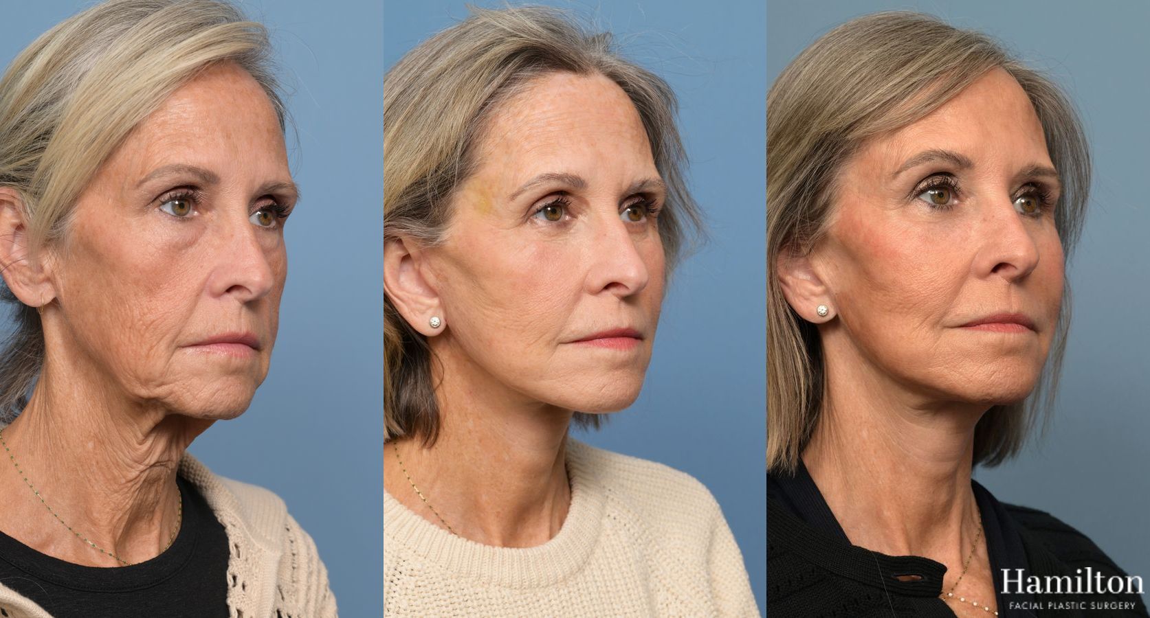 Before and after Facelift - Extended Deep Plane case 37219 - Angle 2