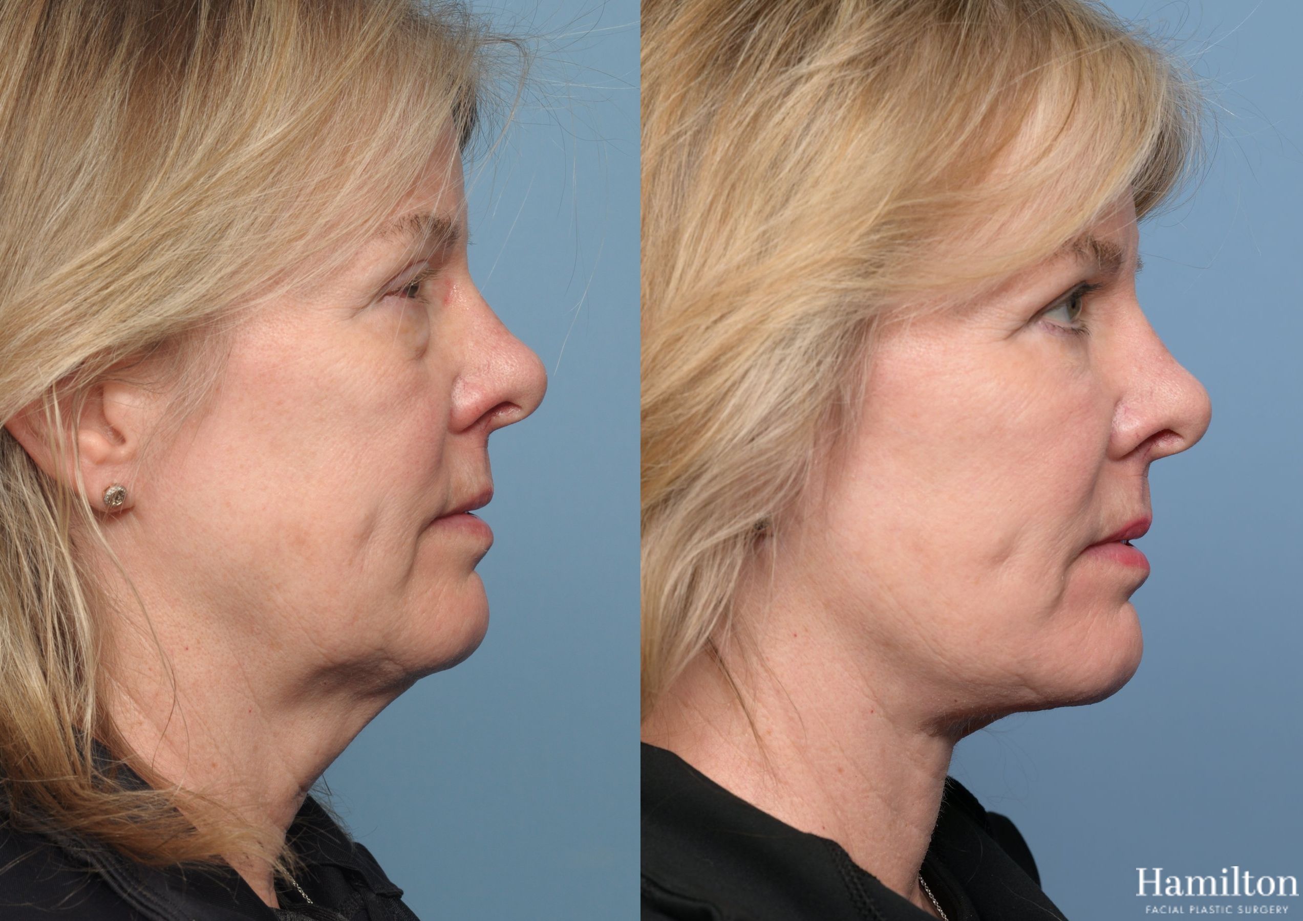 Fat Graph Fat Grafting Archives | Hamilton Facial Plastic Surgery