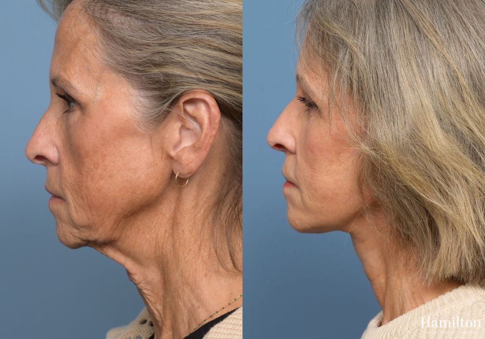 Before and after Fat Grafting case 37098 - Angle 5