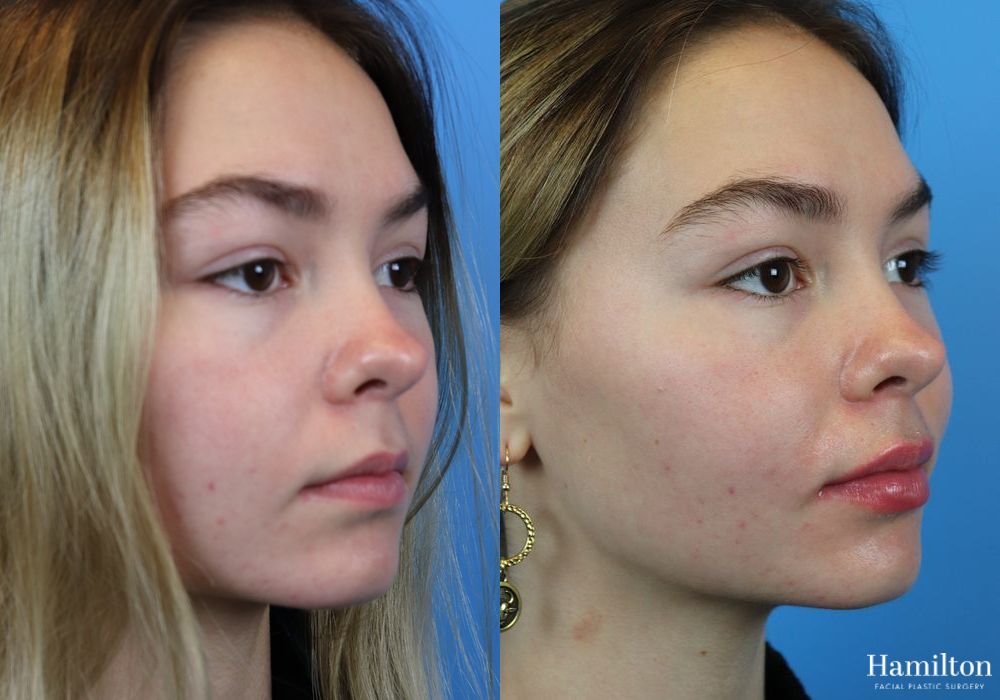 Before and after Fillers case 37084 - Angle 4