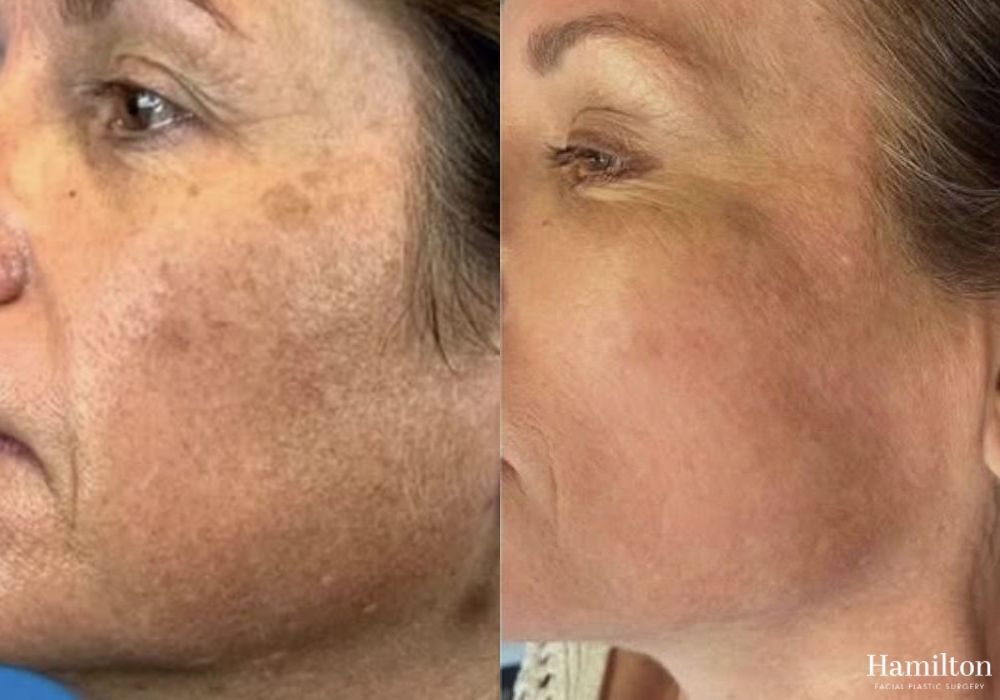 Before and after Laser - Broad Band Light (BBL) case 37200