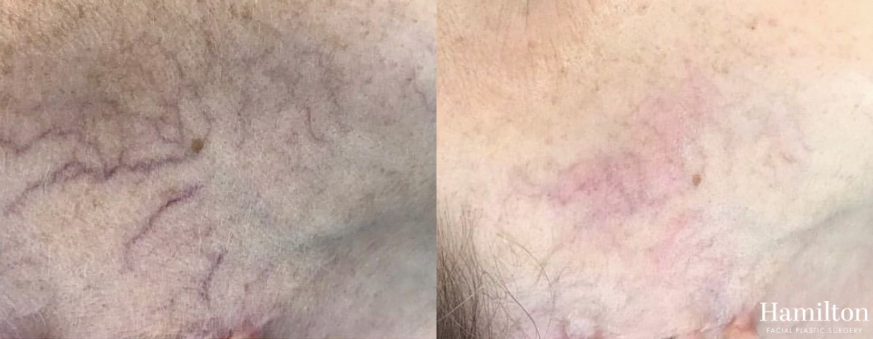 Before and after Laser - Broad Band Light (BBL) case 37121
