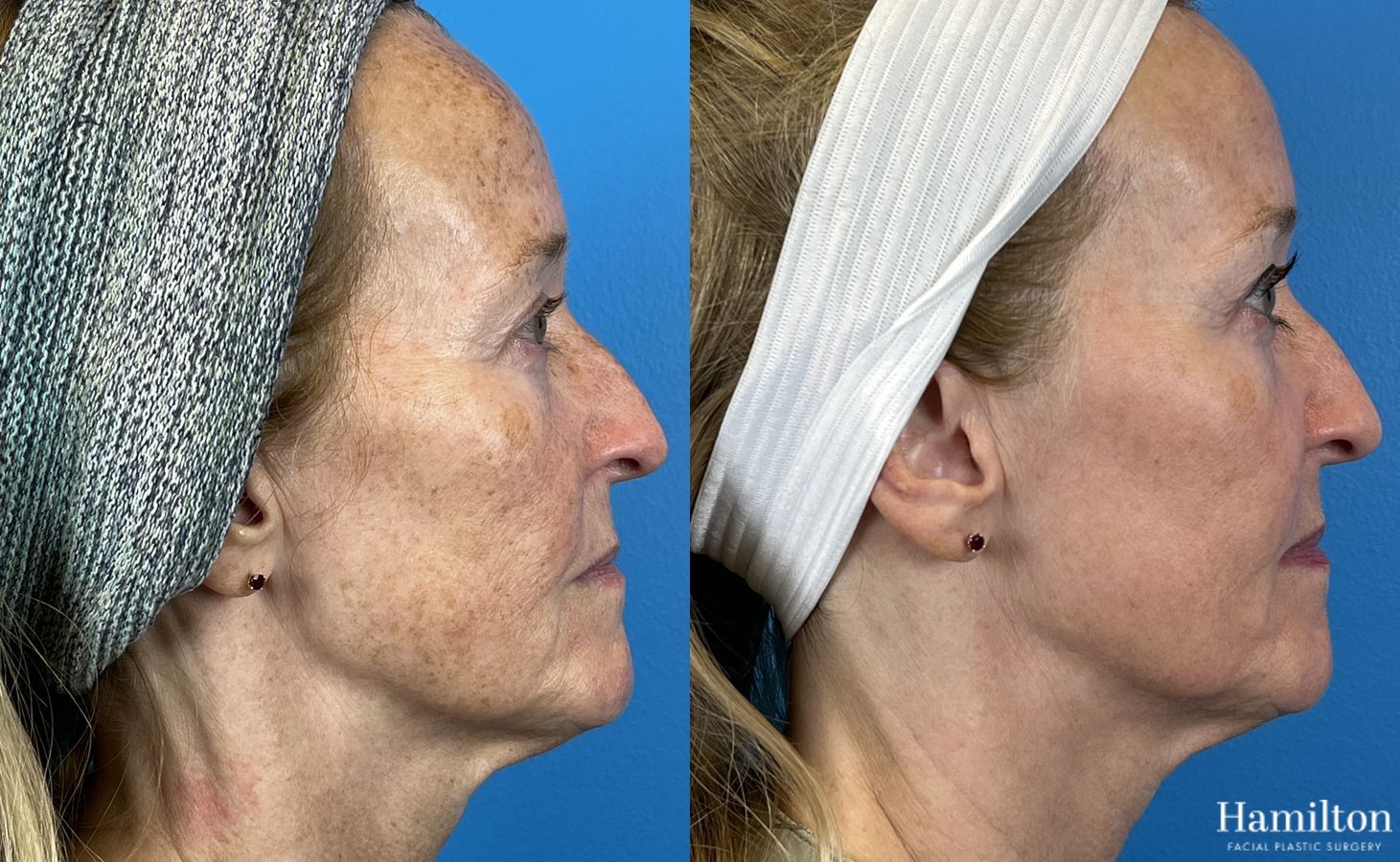 Before and after Laser - Broad Band Light (BBL) case 37099 - Angle 3