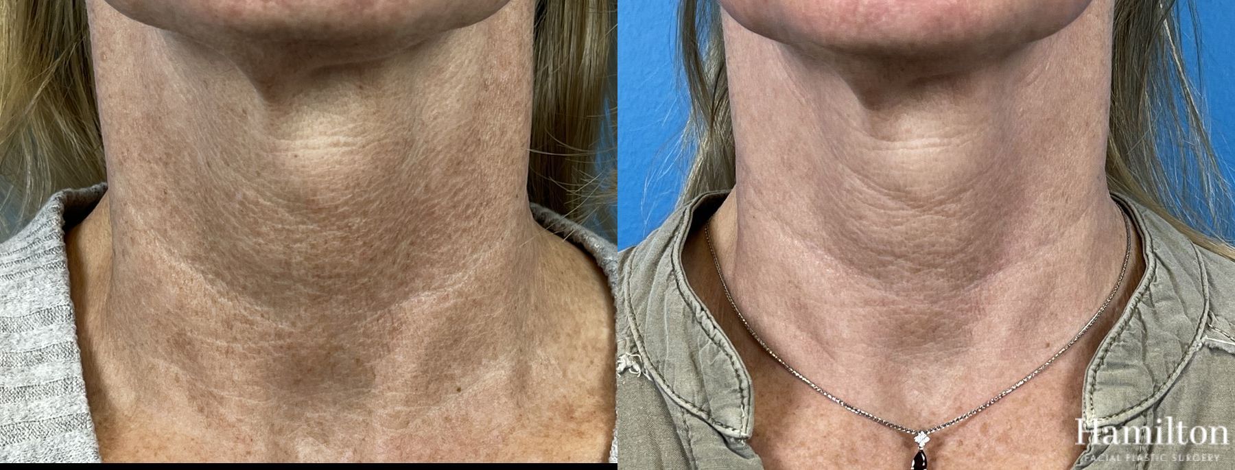 Before and after Laser - Broad Band Light (BBL) case 37099 - Angle 6