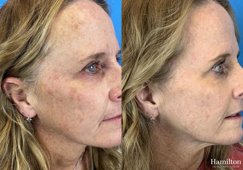 Before and after Laser - Broad Band Light (BBL) case 37213