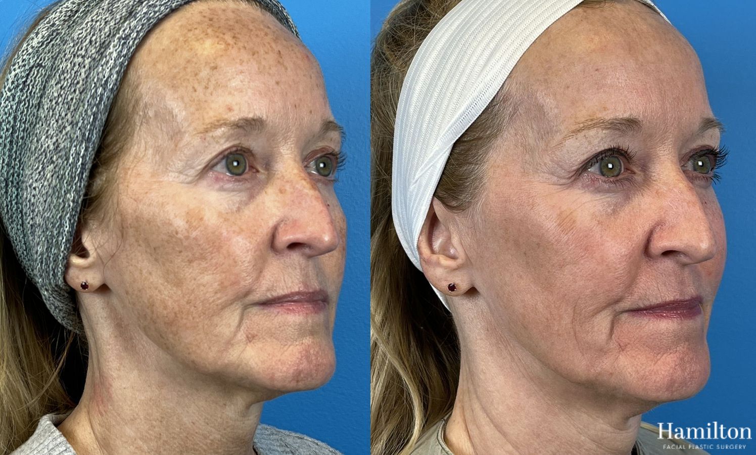 Before and after Laser - Broad Band Light (BBL) case 37099 - Angle 5