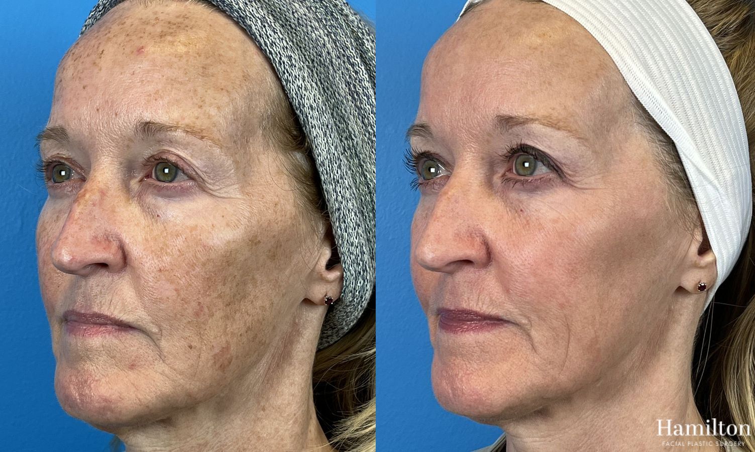 Before and after Laser - Broad Band Light (BBL) case 37099 - Angle 2