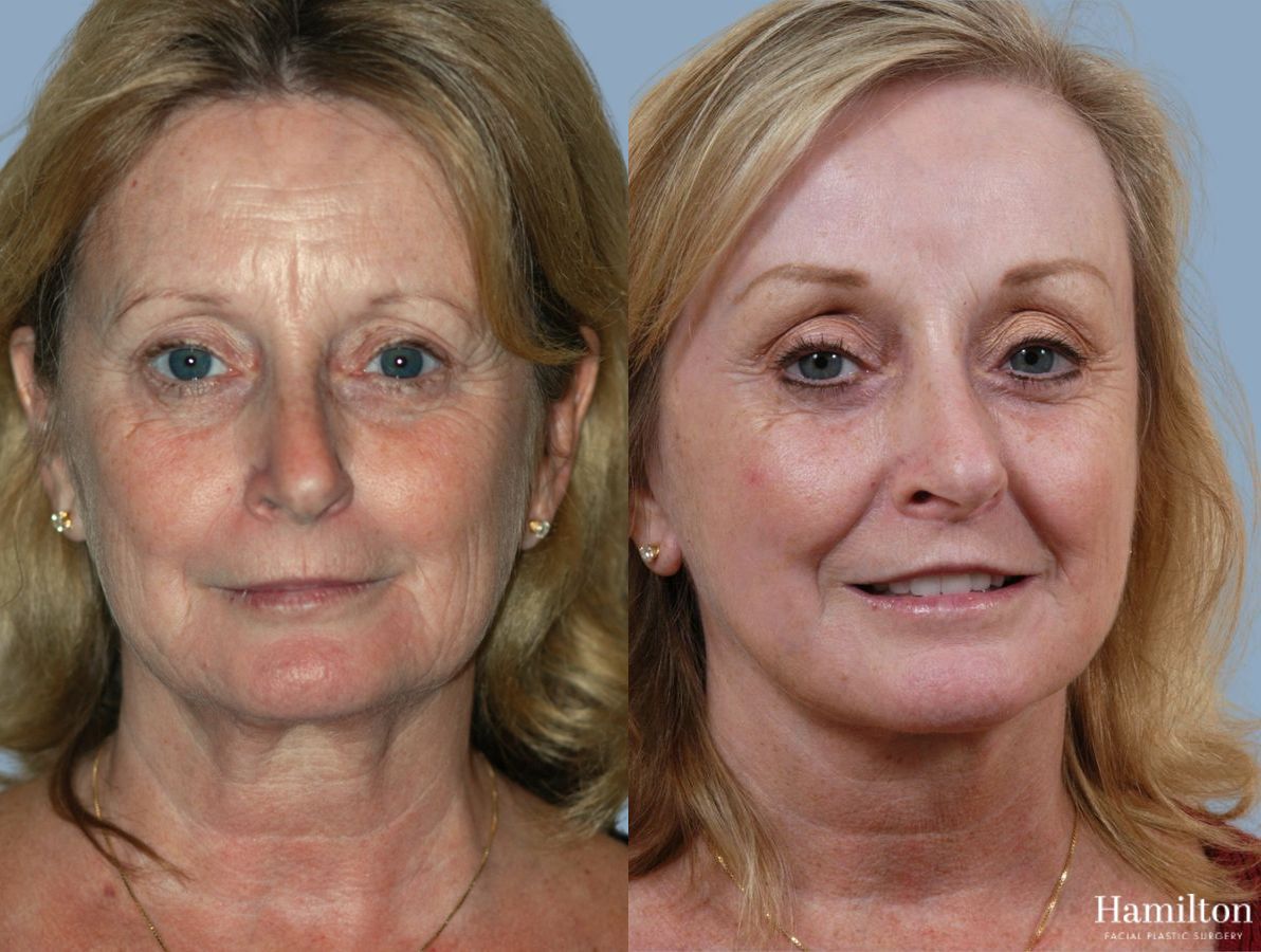 Before and after Laser - CO2 case 37124
