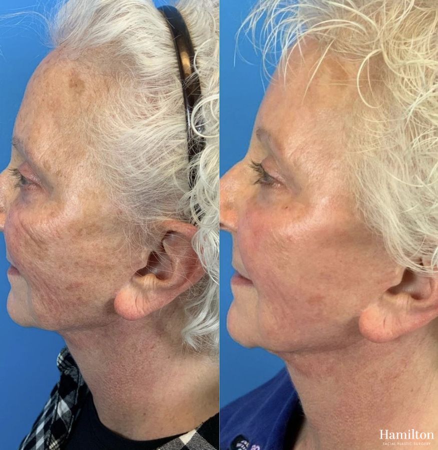 Before and after Laser - HALO case 37360