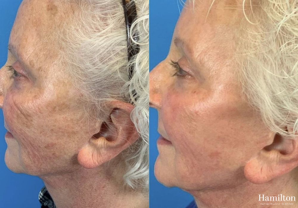 Before and after Laser - HALO case 37360