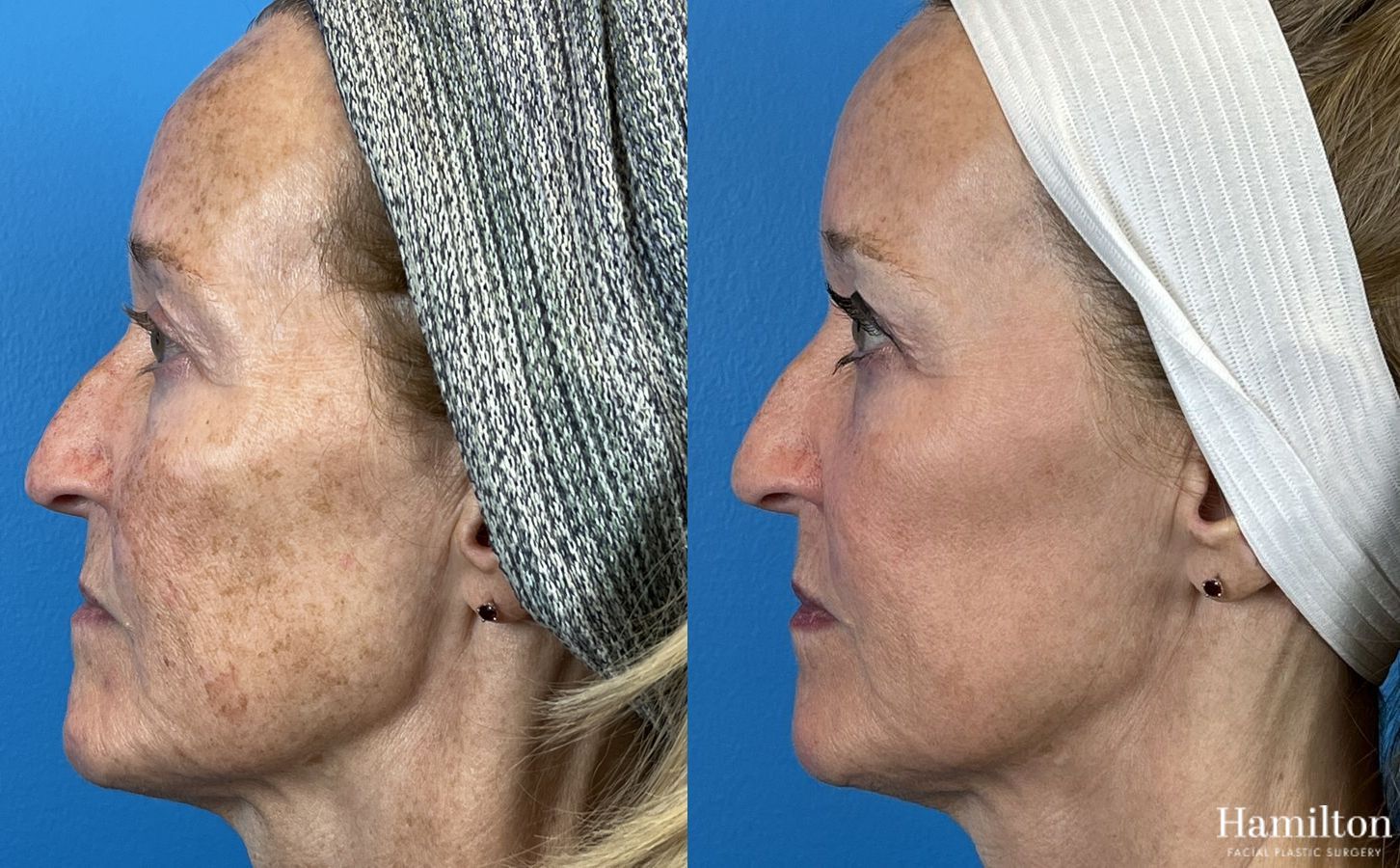 Before and after Laser - HALO case 37364