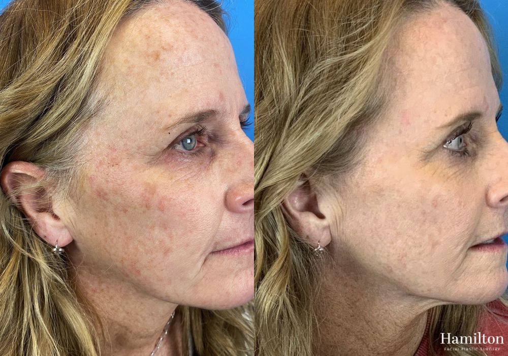 Before and after Laser - HALO case 37363