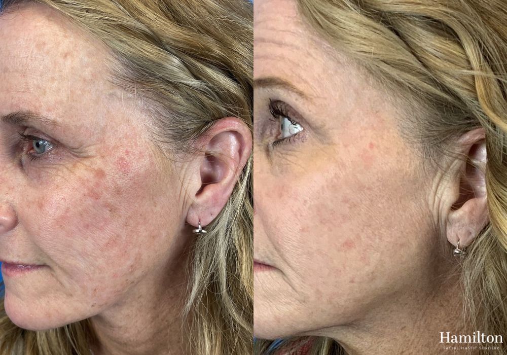 Before and after Laser - HALO case 37363 - Angle 3