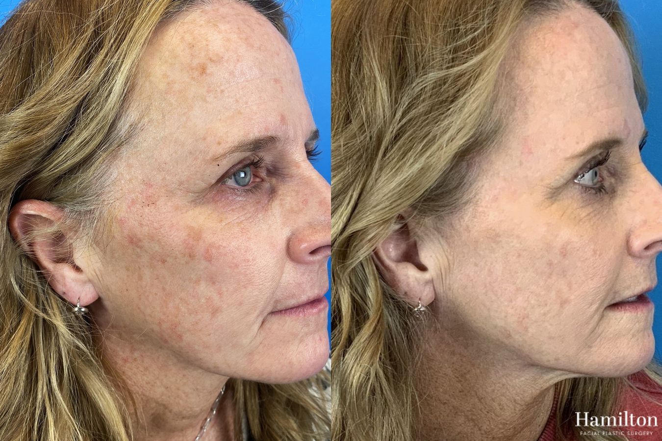 Before and after Laser - HALO case 37363