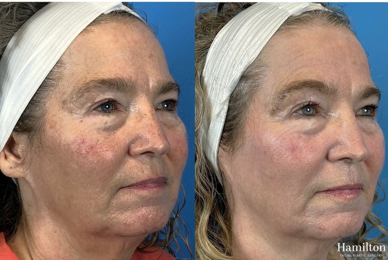 Before and after Laser - HALO case 37362