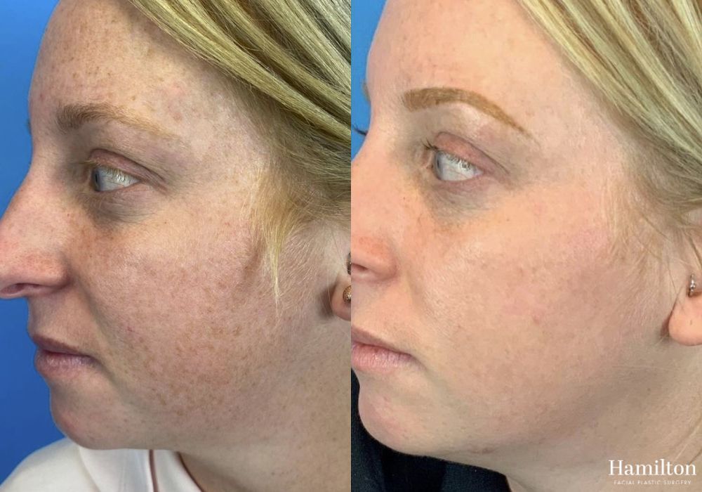 Before and after Laser - MOXI case 37345 - Angle 3