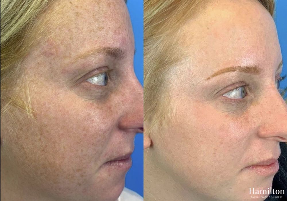 Before and after Laser - MOXI case 37345 - Angle 2