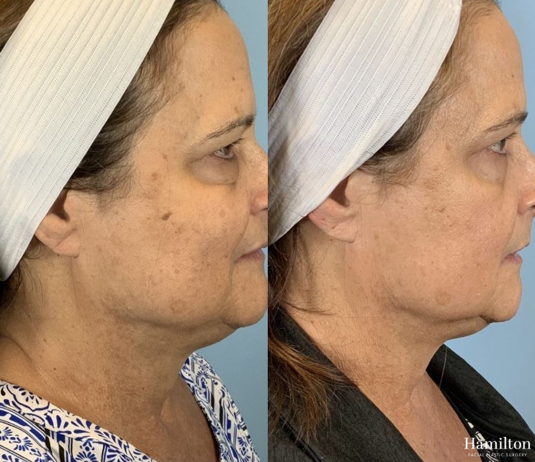 Before and after Laser - MOXI case 37348