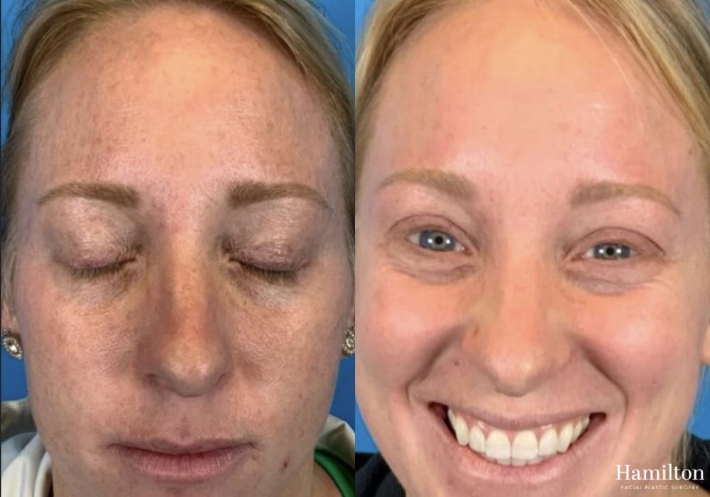 Before and after Laser - MOXI case 37345