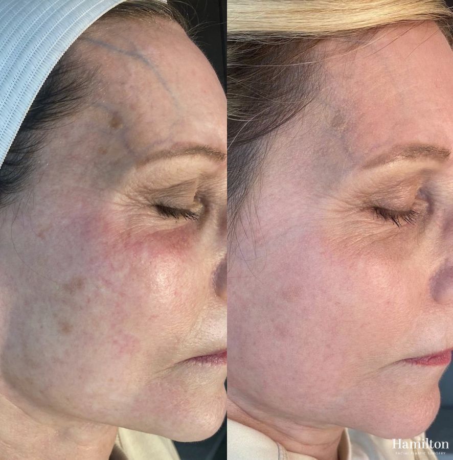 Before and after Laser - MOXI case 37340
