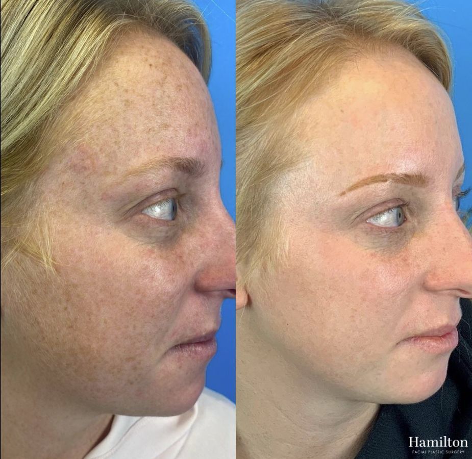 Before and after Laser - MOXI case 37345