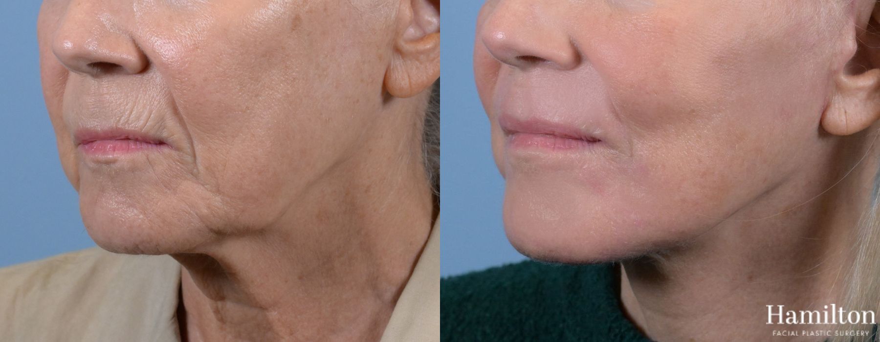 Before and after Laser - Sciton case 37089 - Angle 2