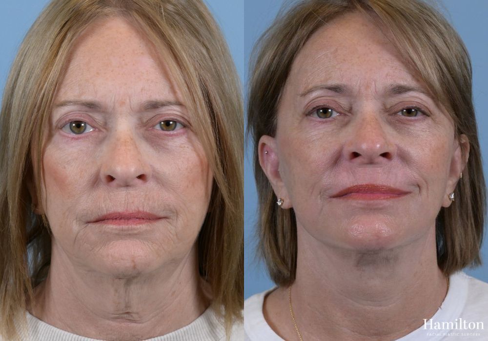 Before and after Laser - Sciton case 37118