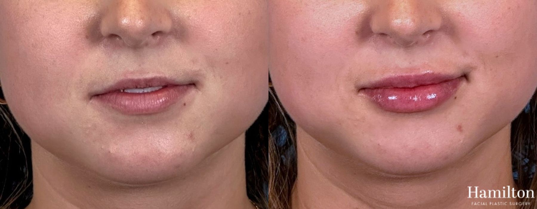 Before and after Lip Enhancement case 37106
