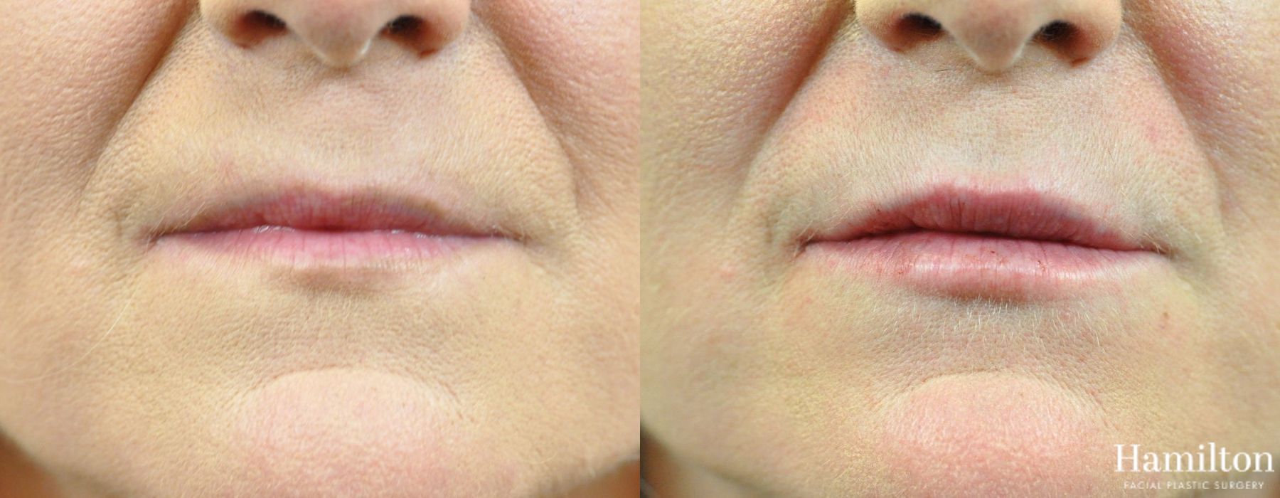 Before and after Lip Enhancement case 37206 - Angle 2