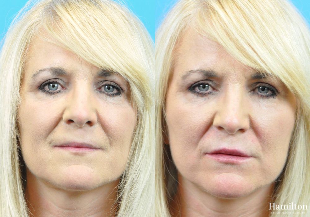 Before and after Lip Enhancement case 37206