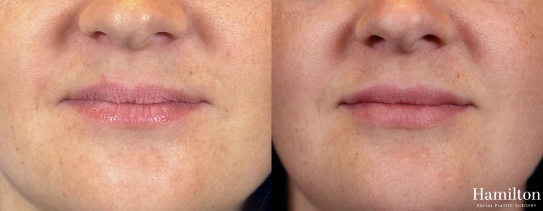 Before and after Lip Enhancement case 37152 - Angle 2