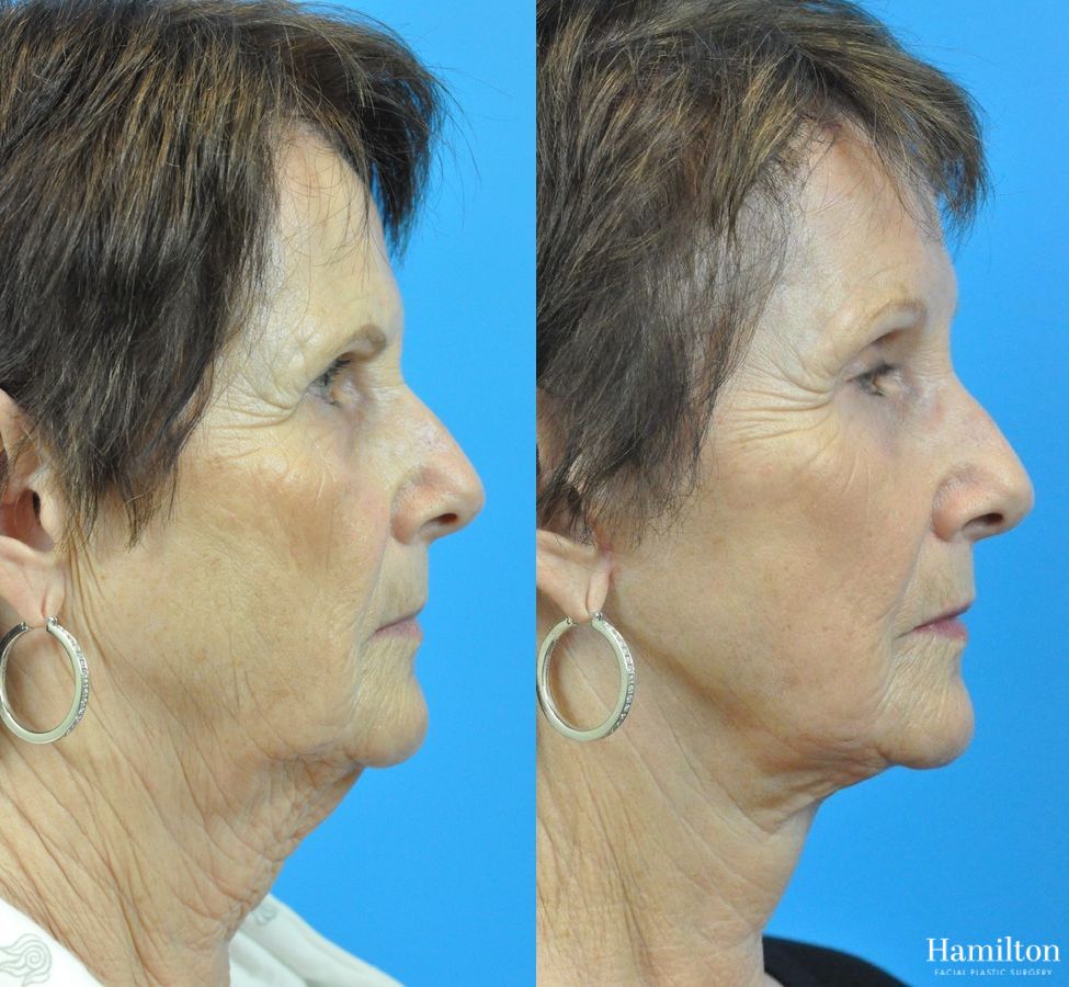 Before and after Neck Rejuvenation case 37223 - Angle 2