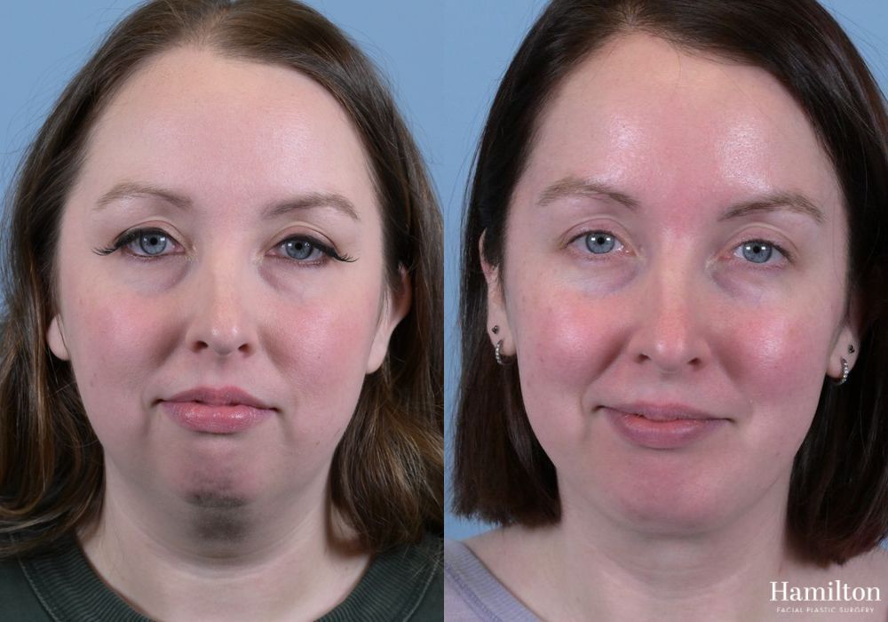 Before and after Neck Rejuvenation case 37159 - Angle 3