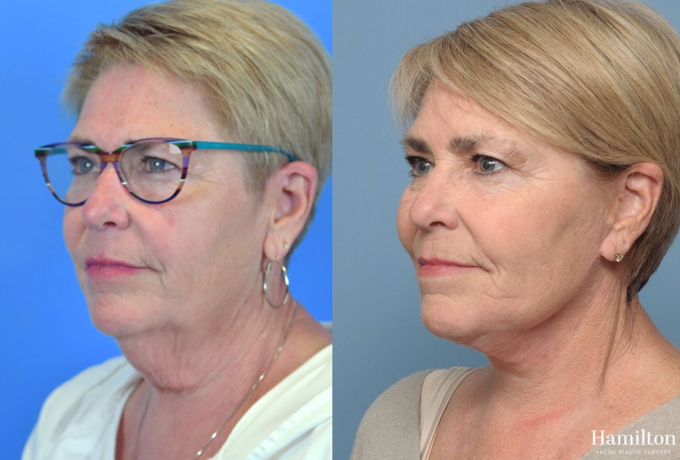 Before and after Neck Rejuvenation case 37234 - Angle 3