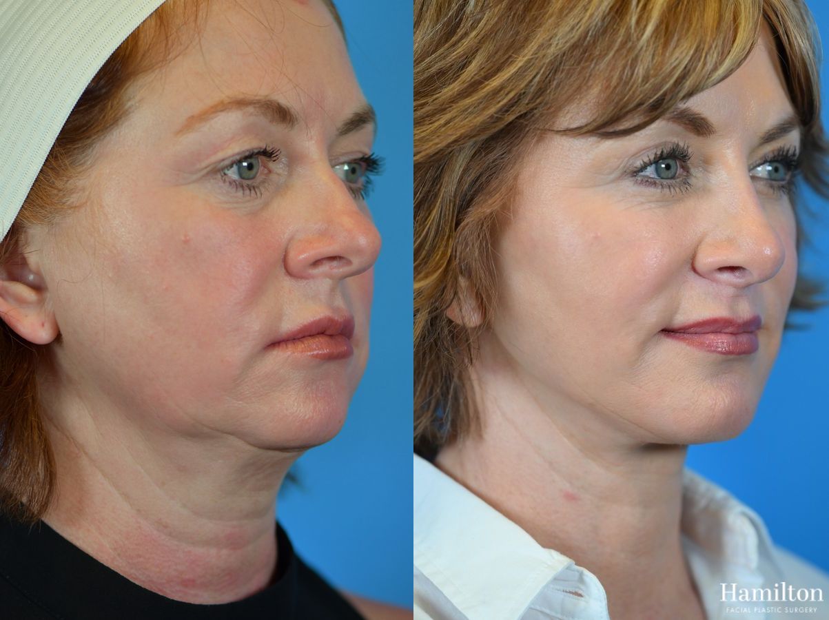 Before and after Neck Rejuvenation case 37168 - Angle 3