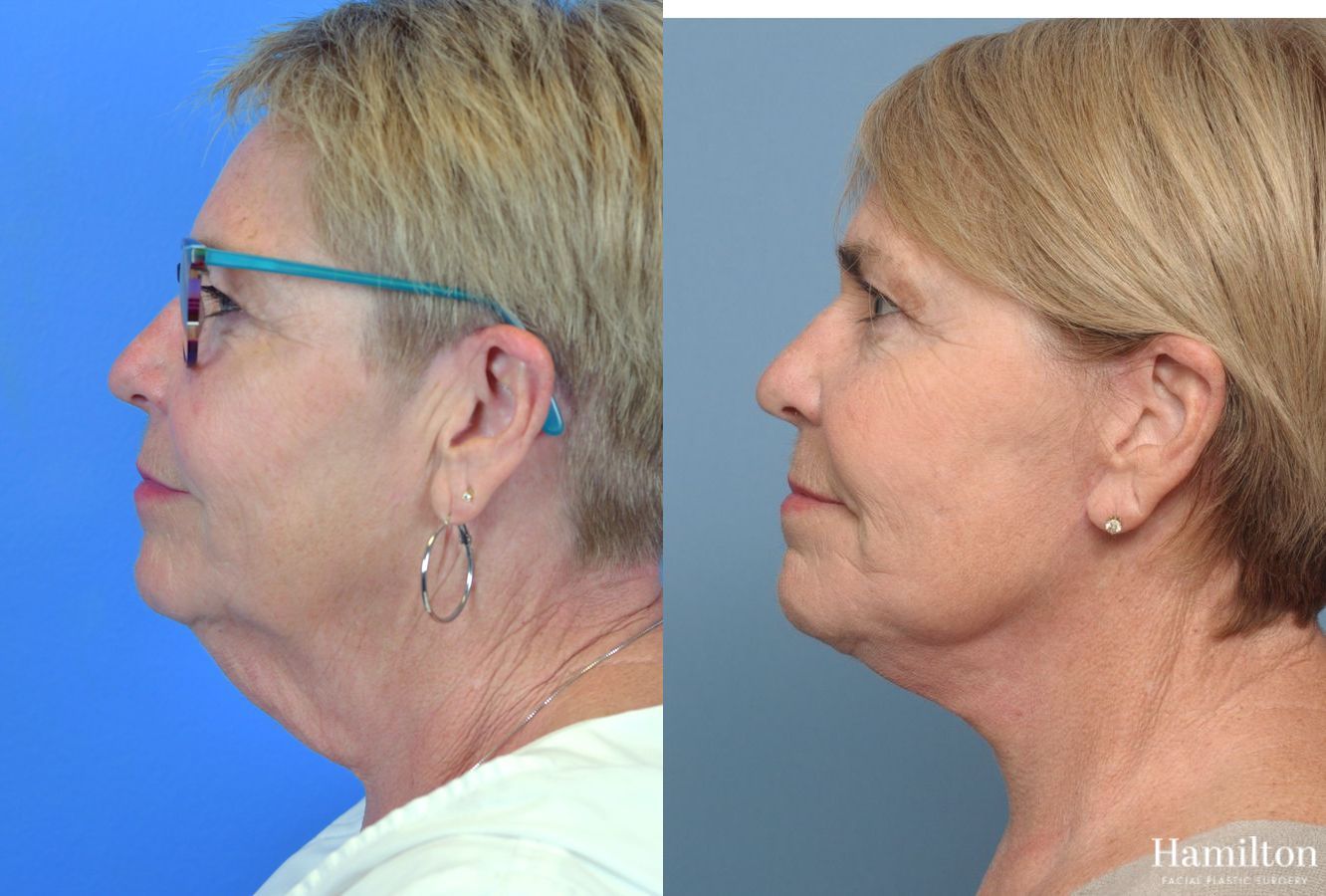 Before and after Neck Rejuvenation case 37234