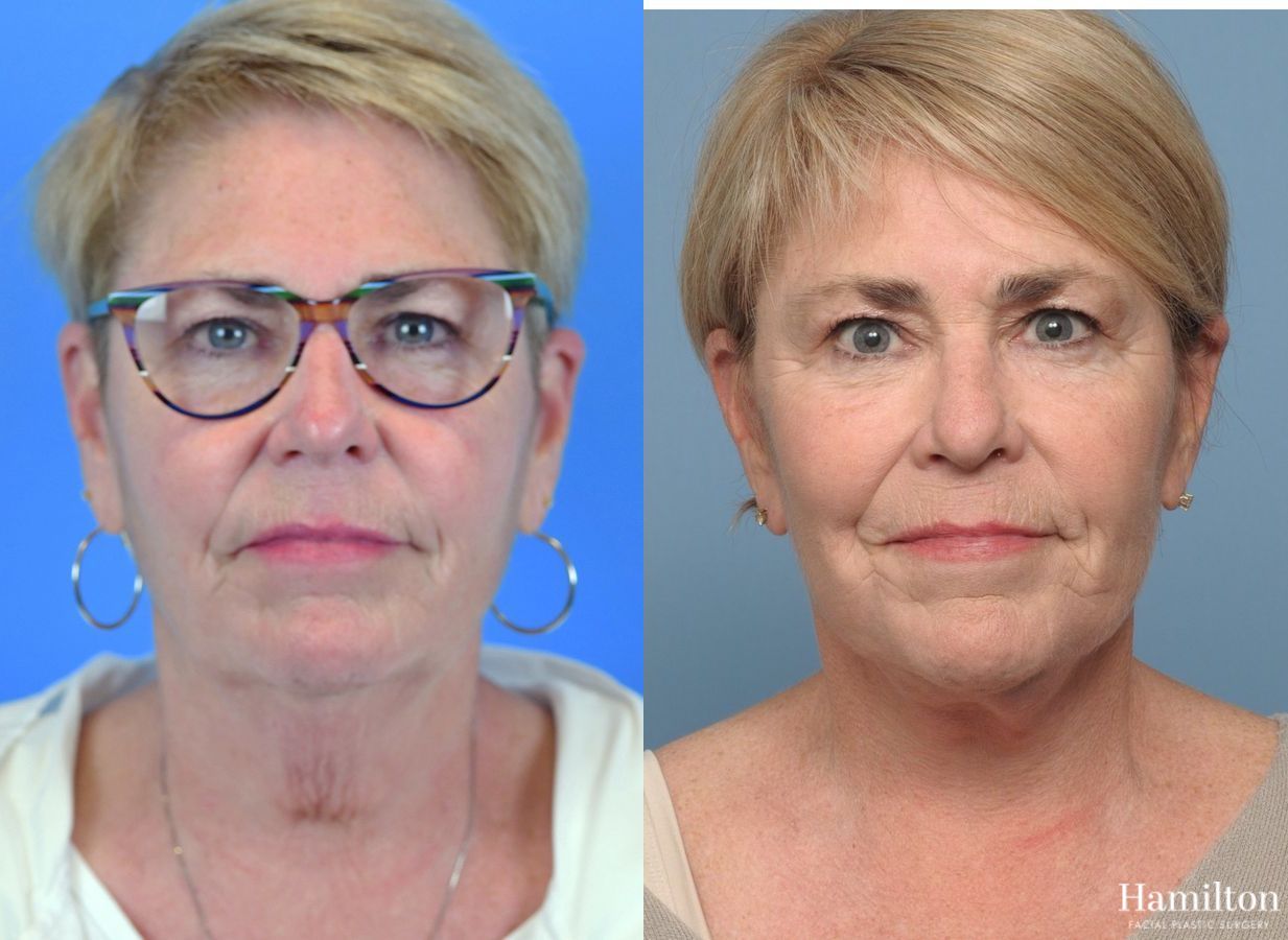 Before and after Neck Rejuvenation case 37234 - Angle 4