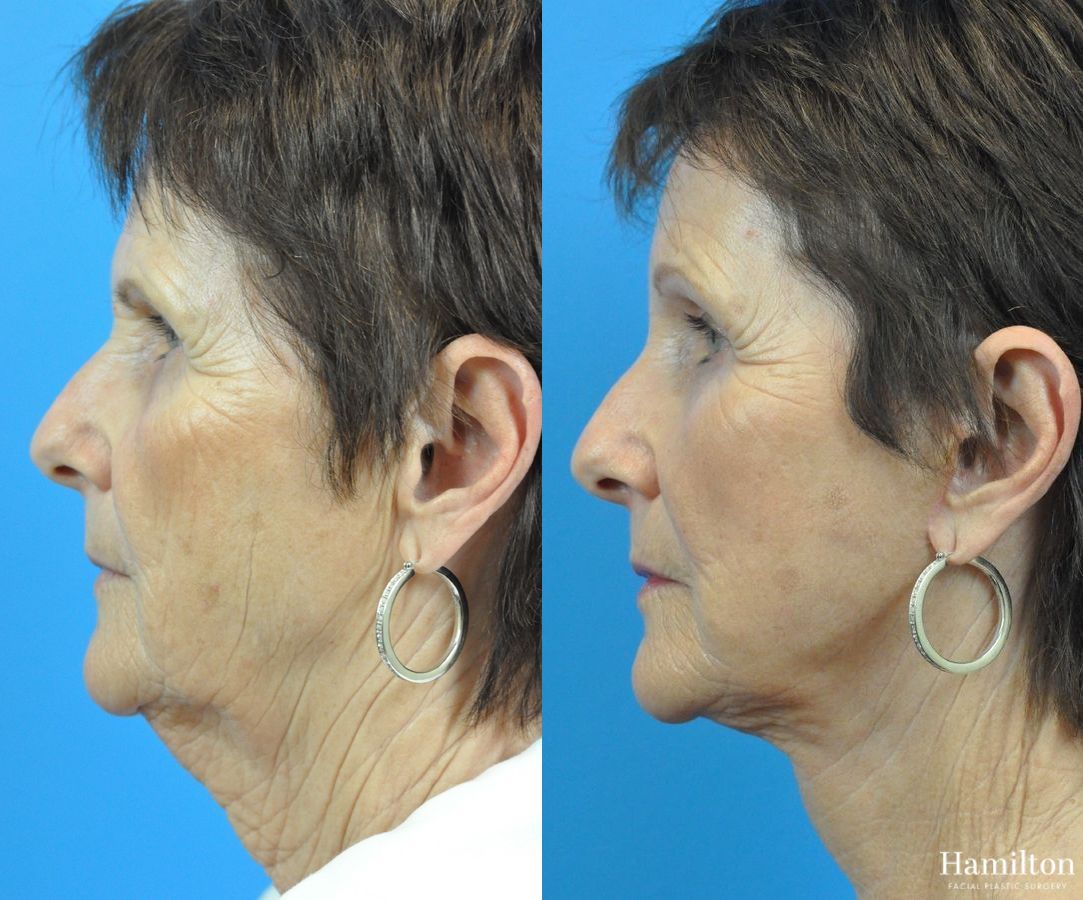 Before and after Neck Rejuvenation case 37223