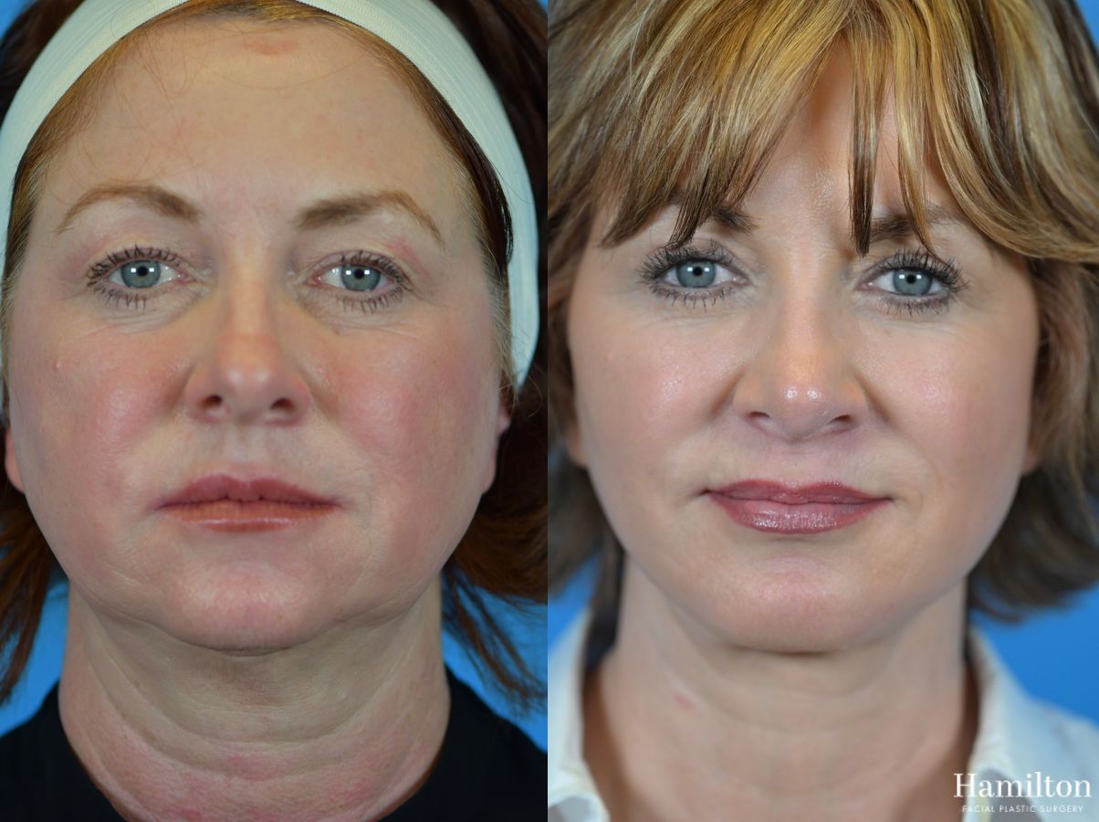 Before and after Neck Rejuvenation case 37168 - Angle 2