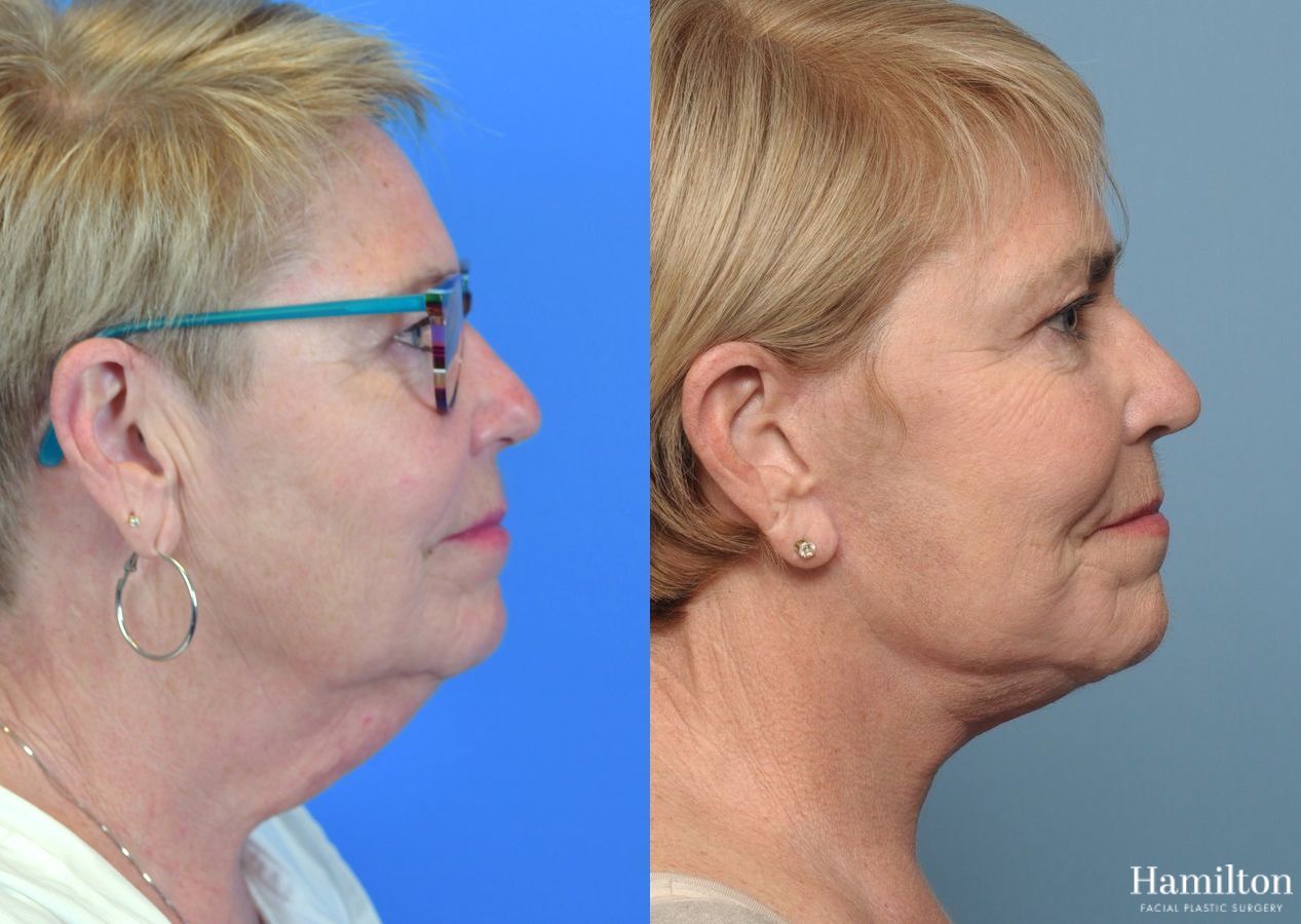 Before and after Neck Rejuvenation case 37234 - Angle 2