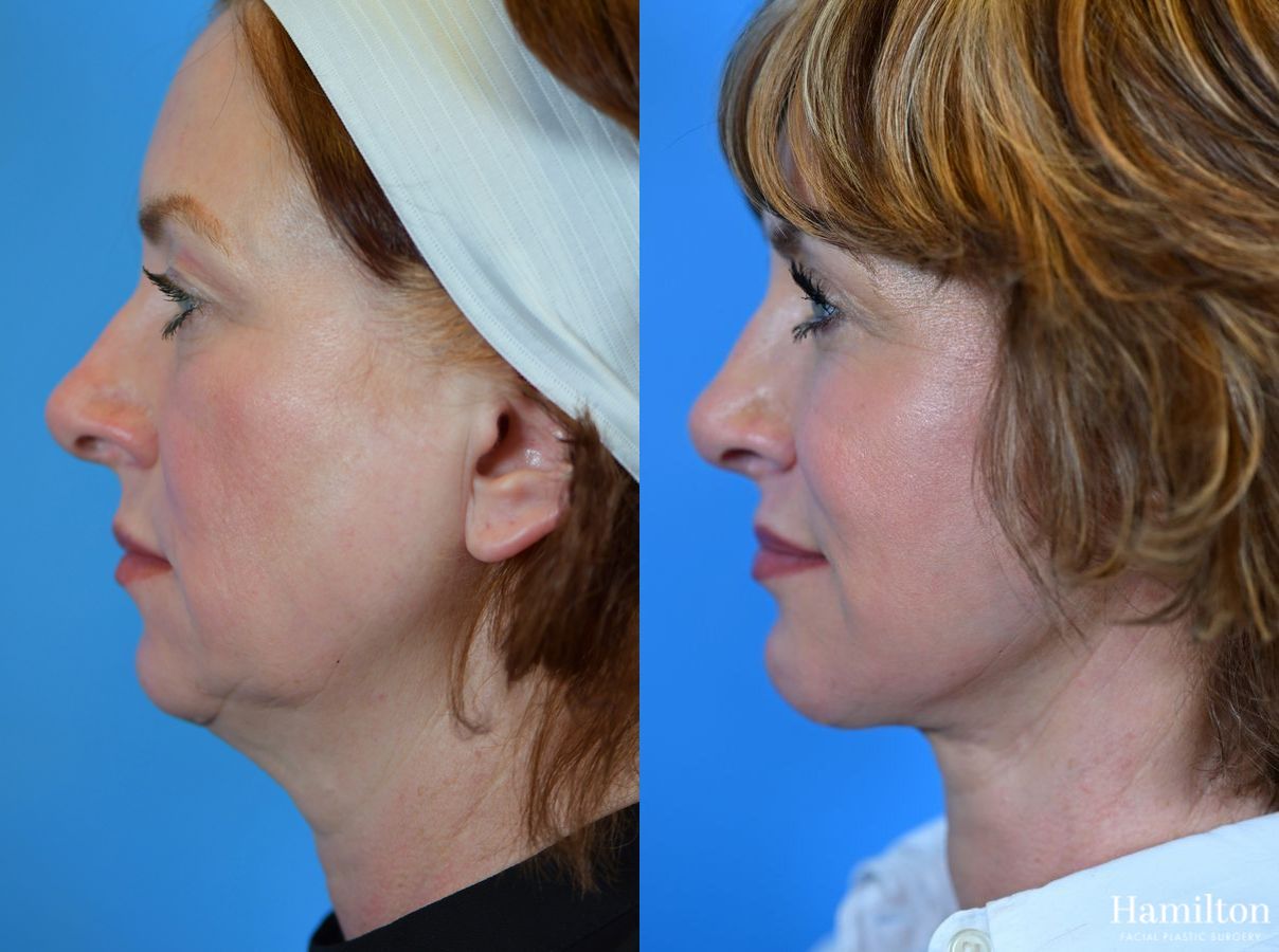 Before and after Neck Rejuvenation case 37168