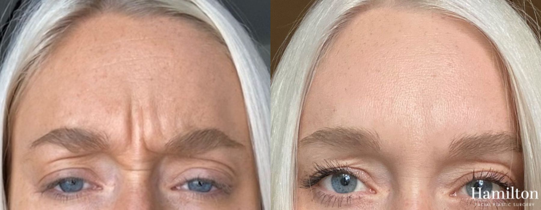 Before and after Neurotoxins/BOTOX case 37101