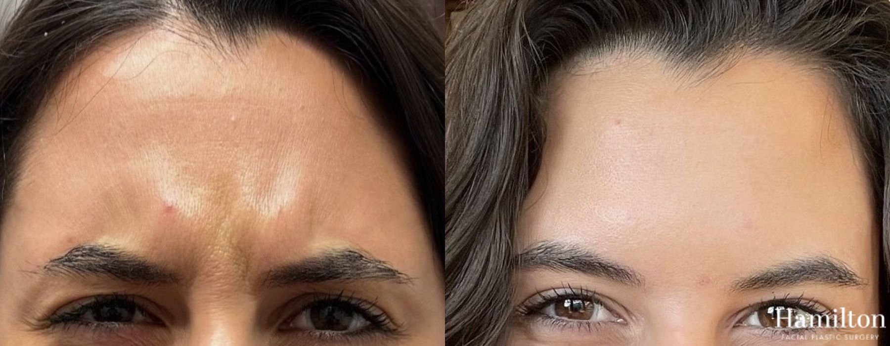 Before and after Neurotoxins/BOTOX case 37182