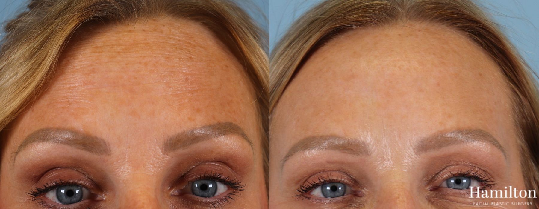 Before and after Neurotoxins/BOTOX case 37146