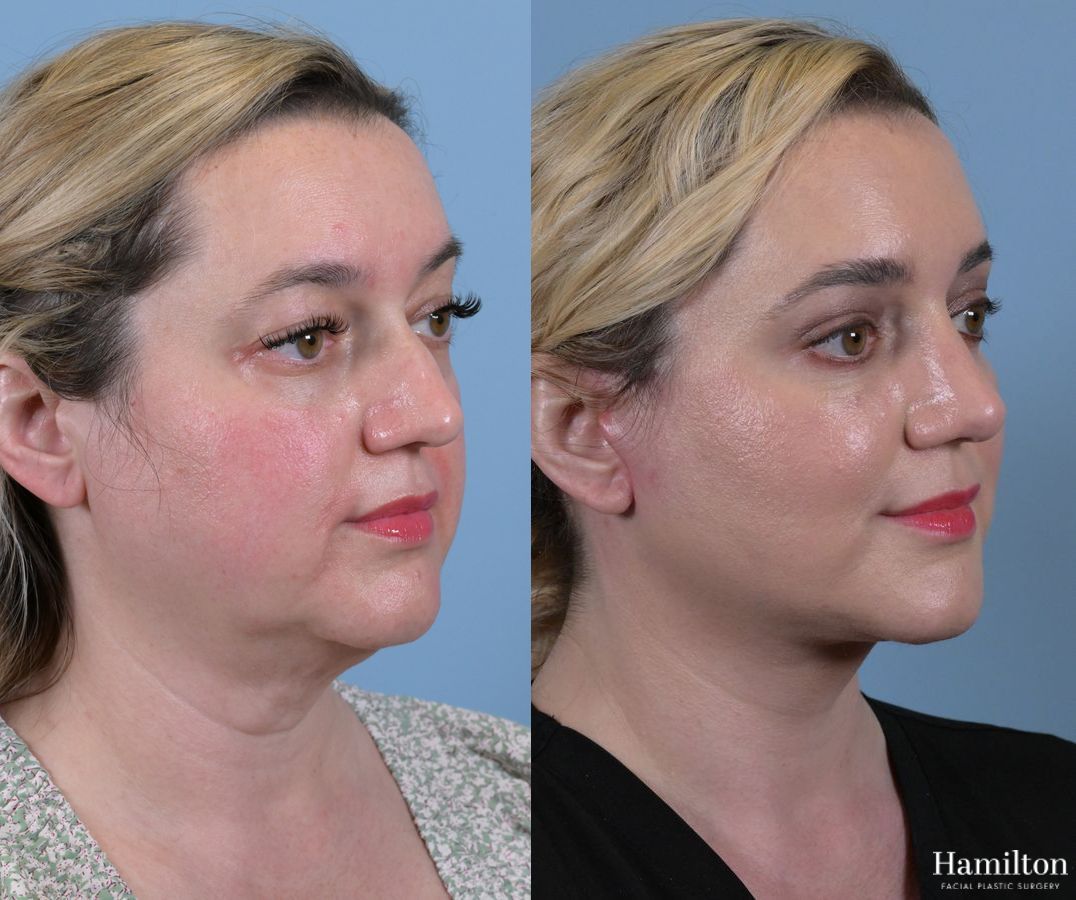 Before and after Rhinoplasty case 37276