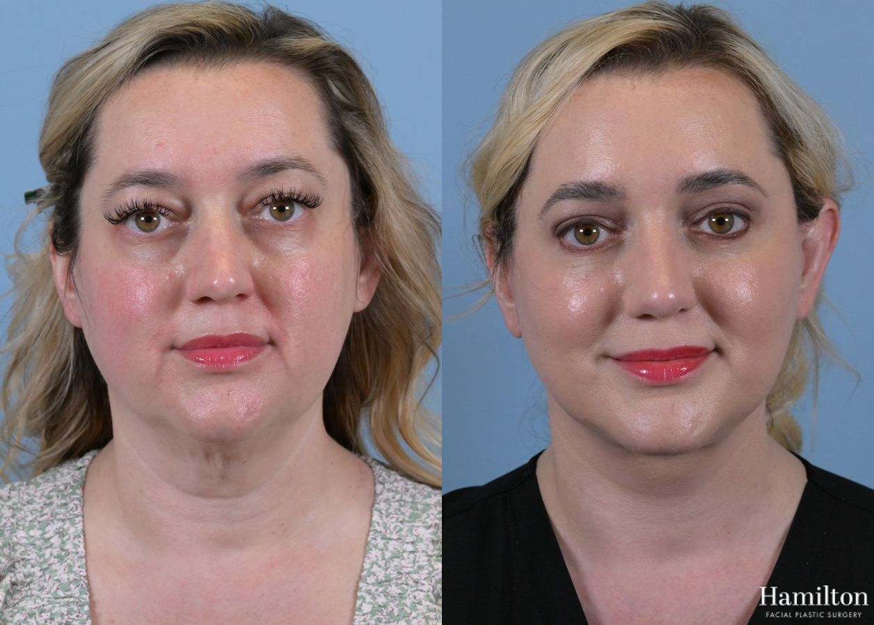 Before and after Rhinoplasty case 37276 - Angle 5