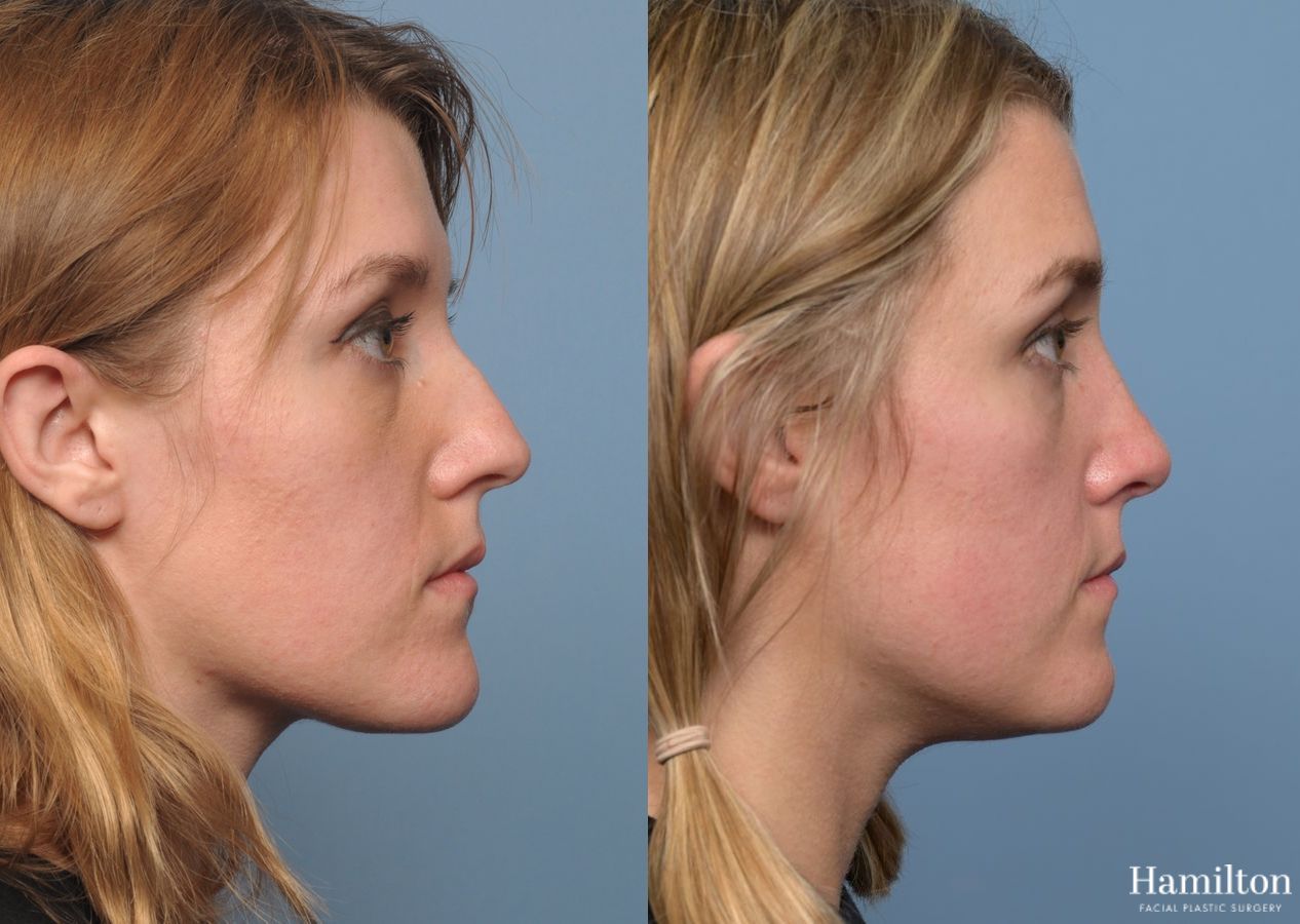 Before and after Rhinoplasty case 37136