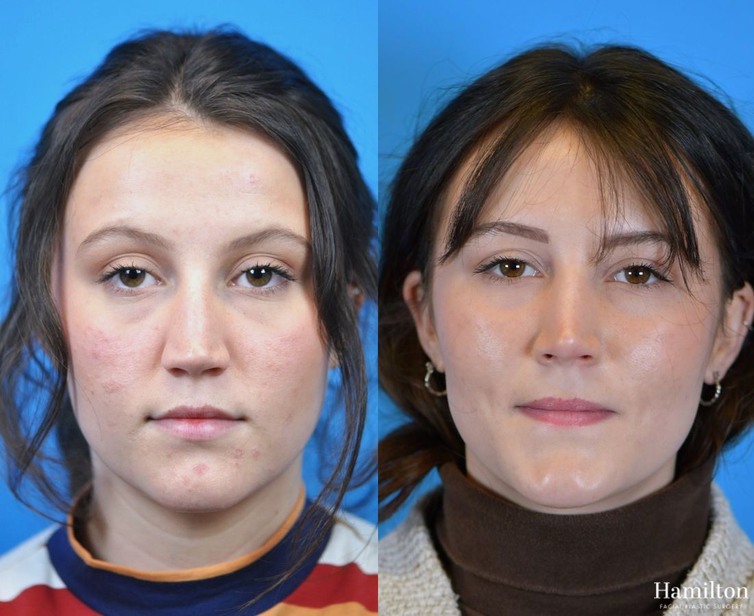 Before and after Rhinoplasty case 37275 - Angle 5